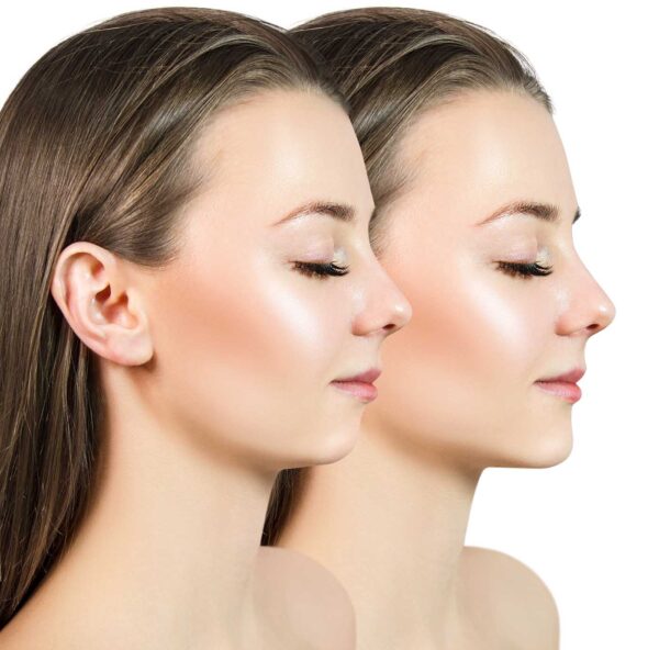 chin augmentation with filler at Skinly Aesthetics