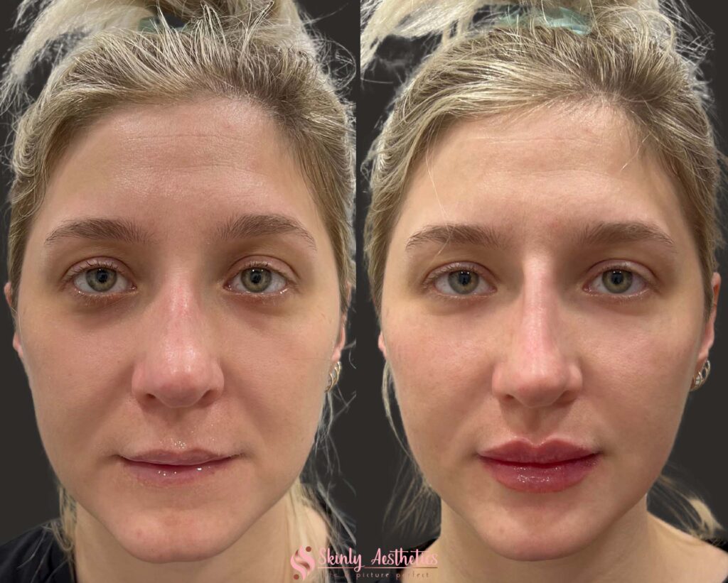before and after results following injection of Juvederm fillers to eliminate dark under eye circles and augment flat cheeks