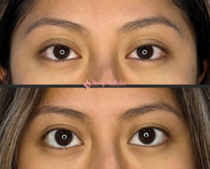 before and after results demonstrating elevation of the upper eyelids following administration of Upneeq eye drops