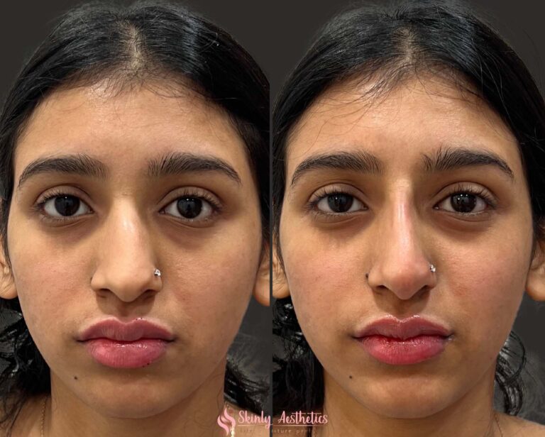 results following nose bridge augmentation with 1ml of Juvederm Voluma