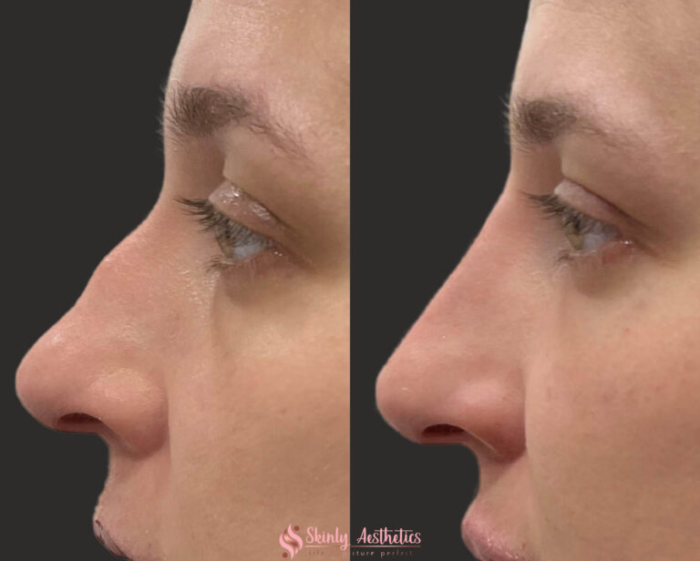 before and after results following non-surgical nose job with Juvederm Voluma