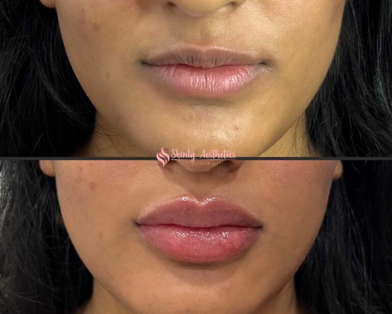 beautiful before and after results showing lip filler augmentation with Juvederm Ultra