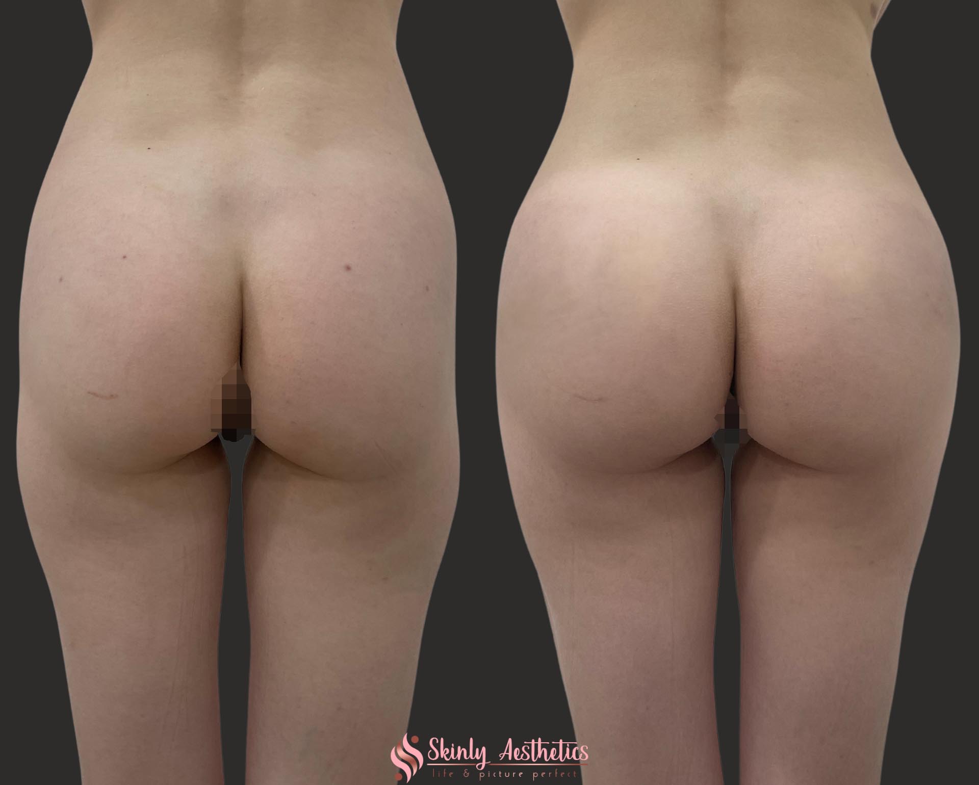 before and after results demonstrating non-surgical butt lift with Sculptra and Radiesse fillers