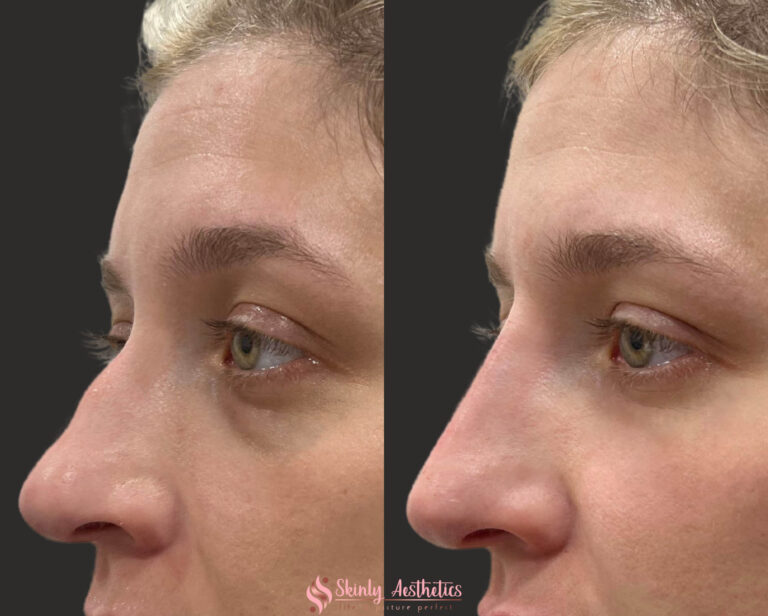 non-surgical rhinoplasty before and after results following nose injection with Juvederm Voluma
