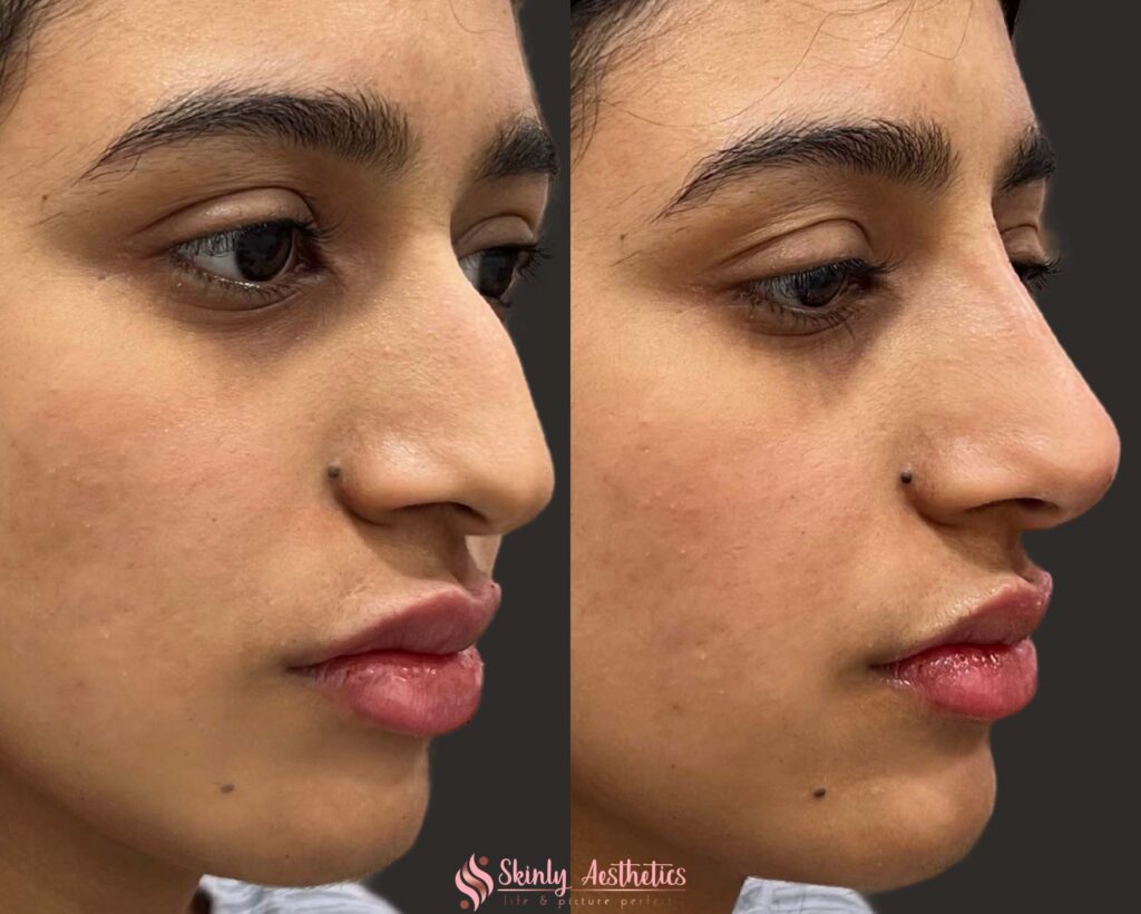 before and after results demonstrating nose straightening with Juvederm Voluma injection
