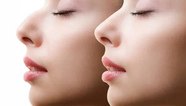 non-surgical rhinoplasty with nose filler at Skinly Aesthetics