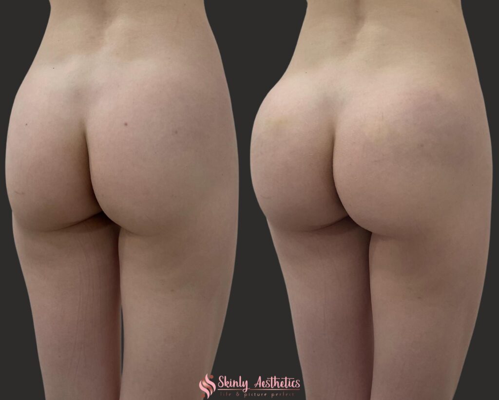 before and after results following posterior non-surgical butt lift with Sculptra and Radiesse fillers