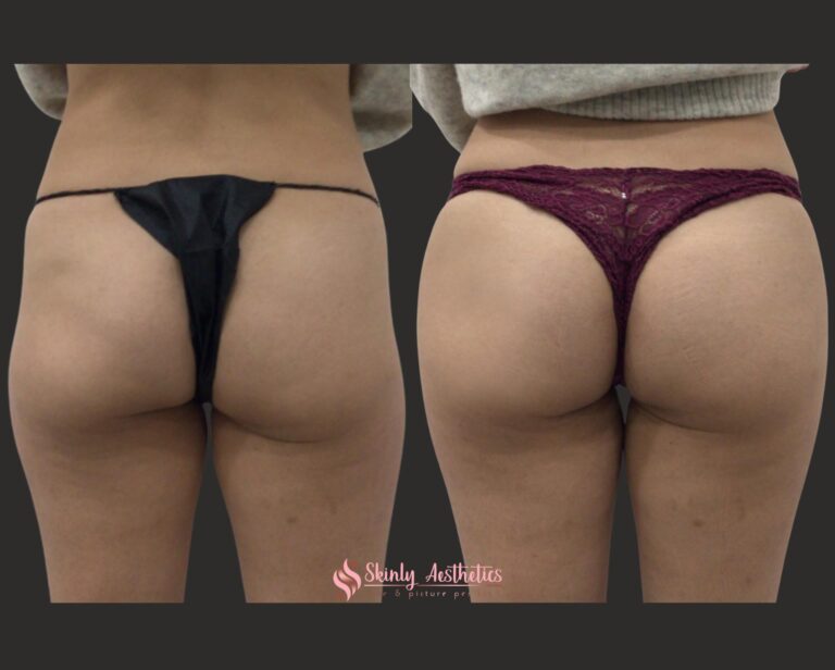 Sculptra Butt Lift - Benefits, Costs, Results & Procedure Steps