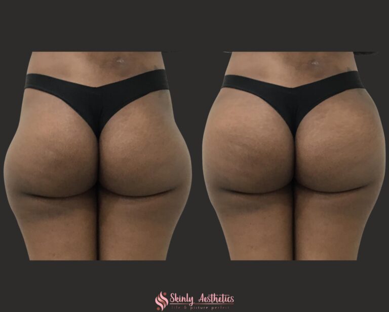 Sculptra Hip Dips - Before and After Results at Skinly Aesthetics