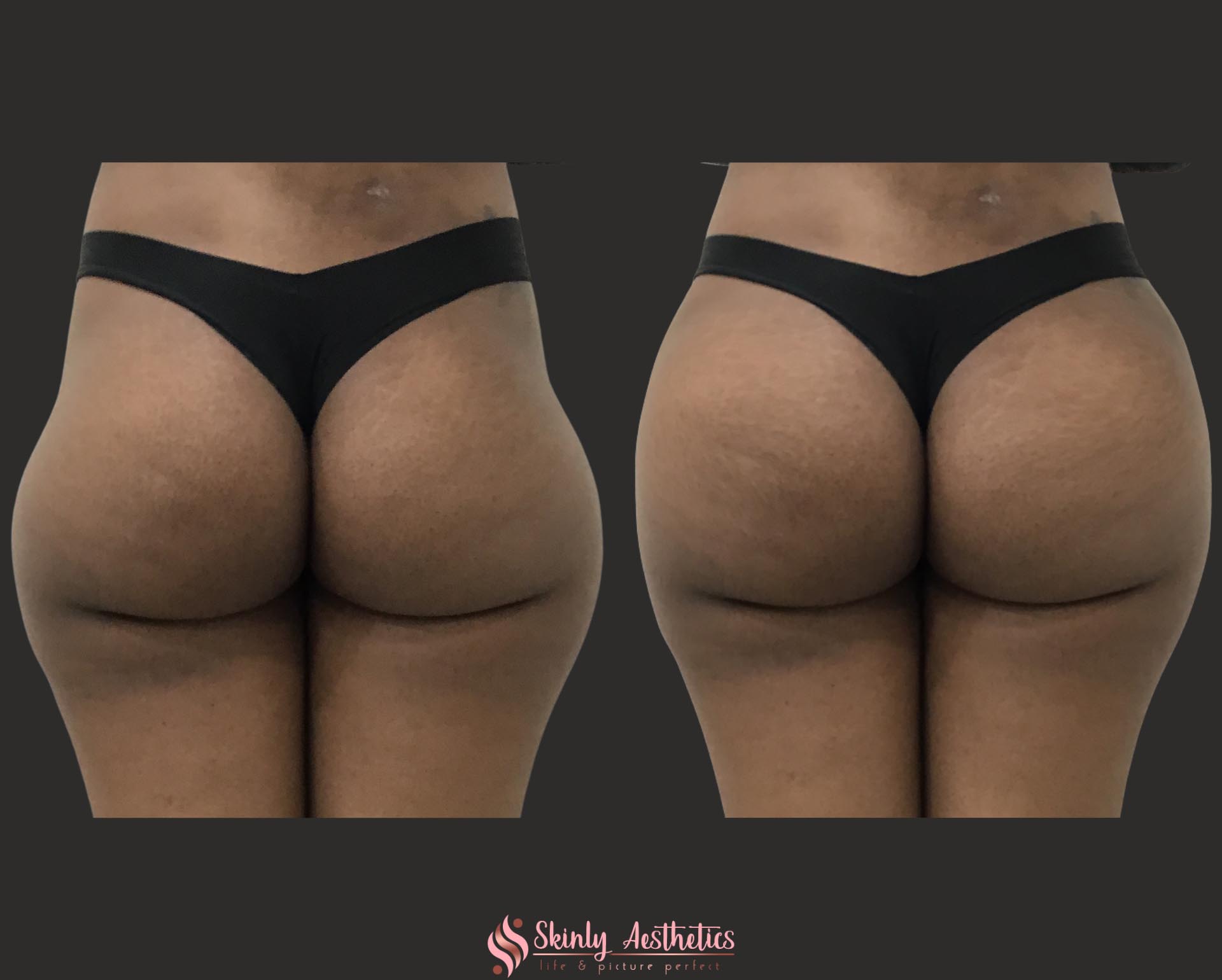 before and after results following correction of severe hip dip deformities with Sculptra and Radiesse fillers