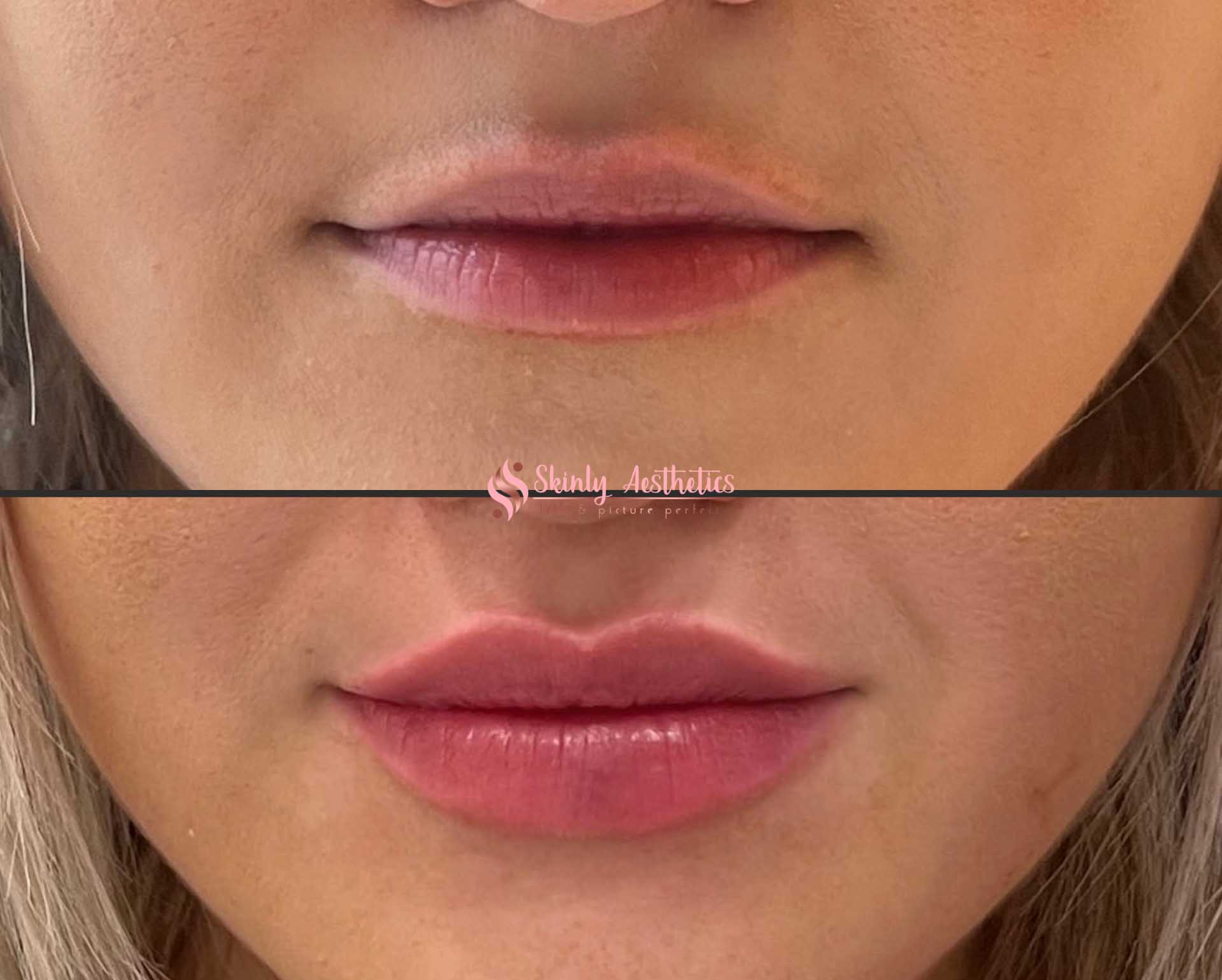 subtle lip enhancement before and results following injection of 1ml of RHA2 filler