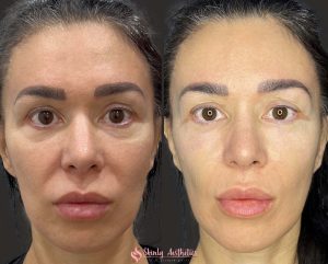 treatment of hollow tear trough region with RHA filler