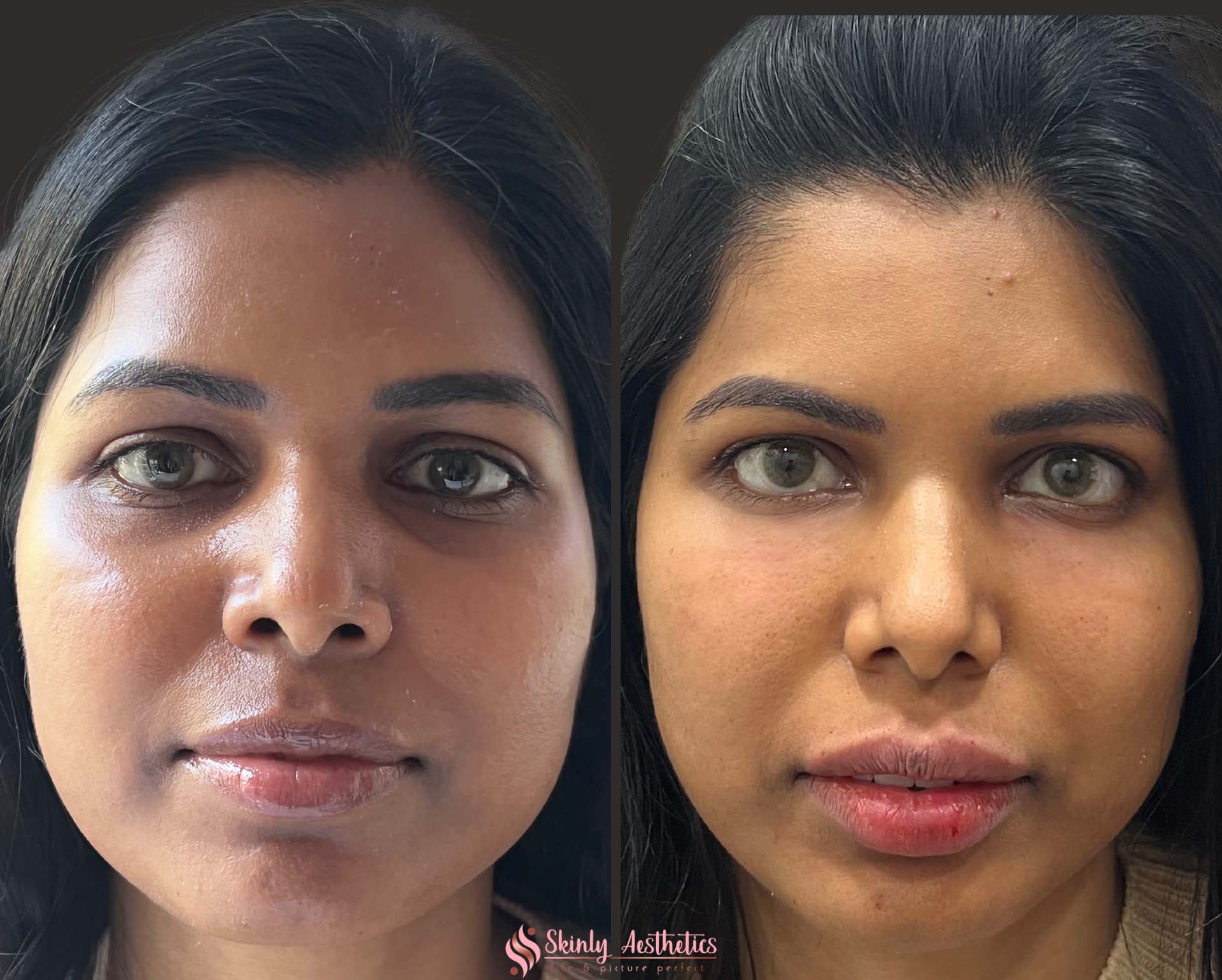 before and after results demonstrating filling of deep under eye bags with RHA filler