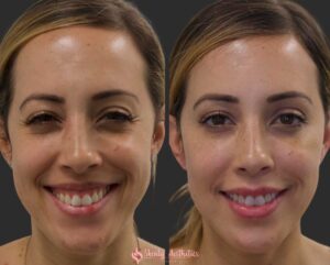 Skinly Aesthetics best botox results NYC