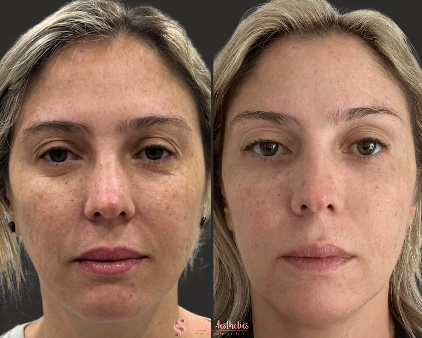 Before and after results of non-surgical blepharoplasty after 3 Pure Plasma treatments