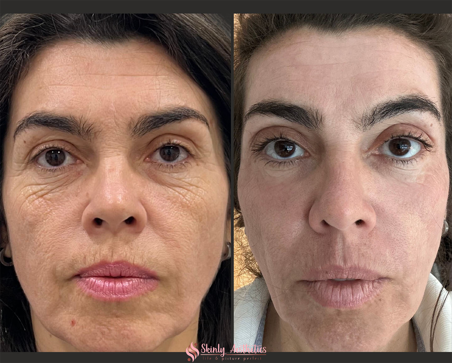 Before and after results upper eyelid lifting after 3 sessions of Pure Plasma