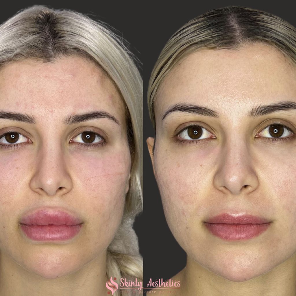 Before and After results after dissolving lip filler with hyaluronidase
