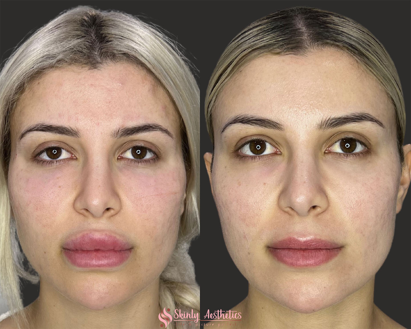 Dermal Filler Removal