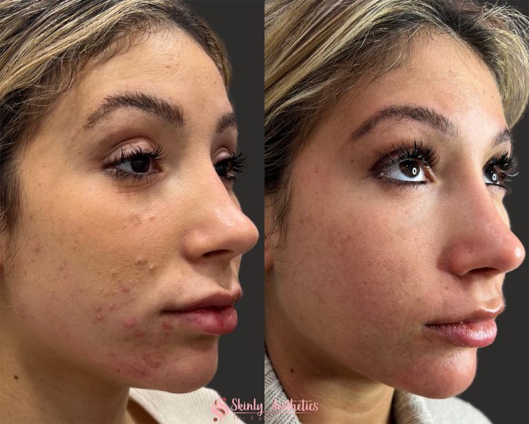 Acne resoluton following 2 treatments with Carbon Laser