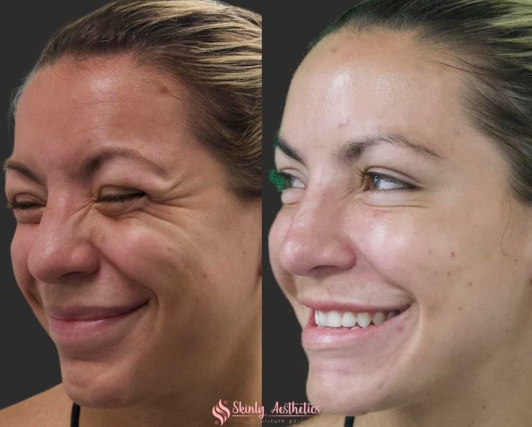 Natural Botox results at Skinly Aesthetics Medspa