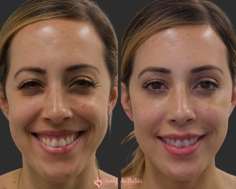 Best Botox results at Skinly MedSpa