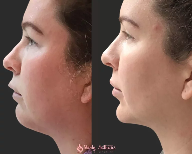 Kybella Double Chin Melting Before and After