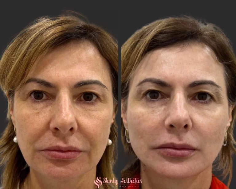 PDO-face-lift-before-after-results