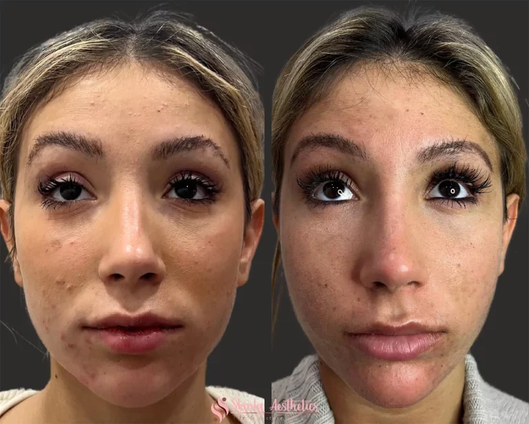 Acne reduction after Carbon laser treatment