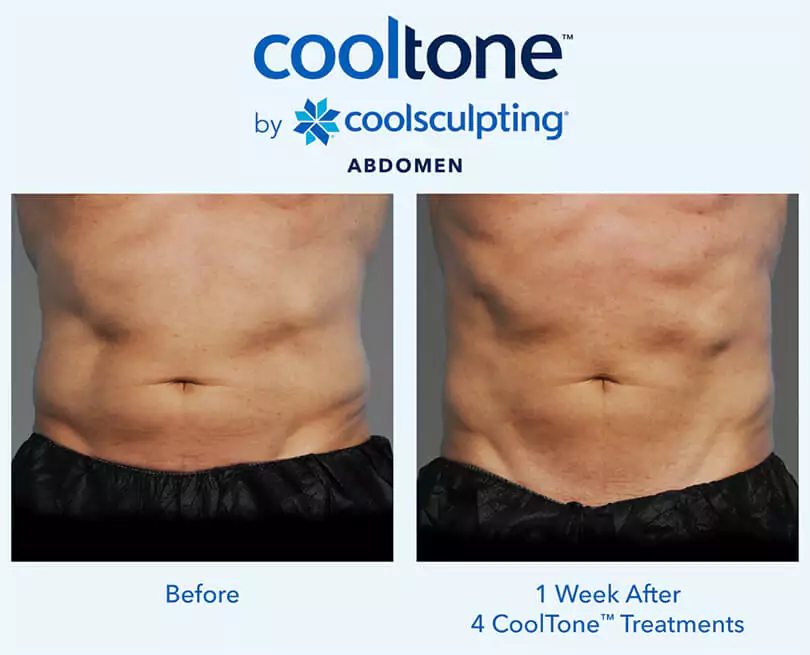 CoolTone-Before-After