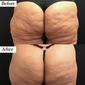 Avéli cellulite reduction on the buttocks, before and after