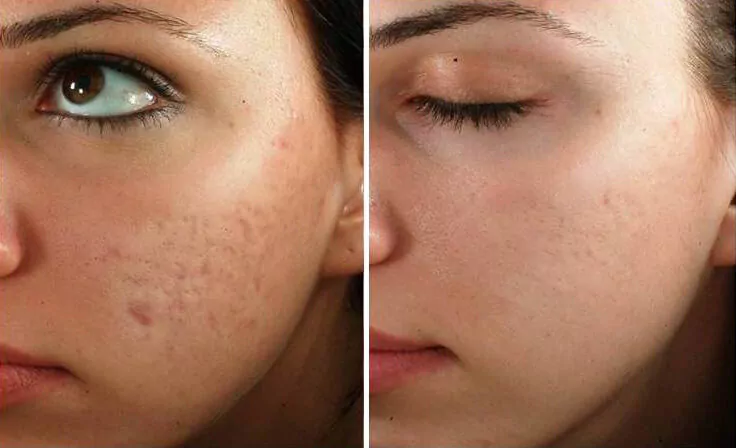 Microneedling before and after results in NYC