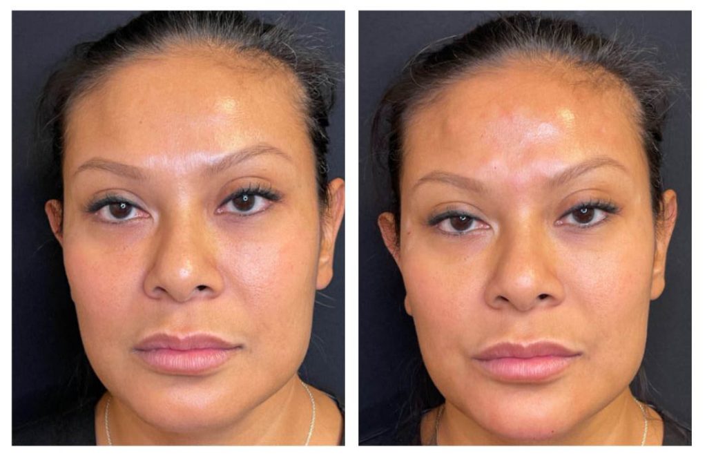 Morpheus8 RF Microneedling | NYC Skin Tightening &amp; Scar Reduction 