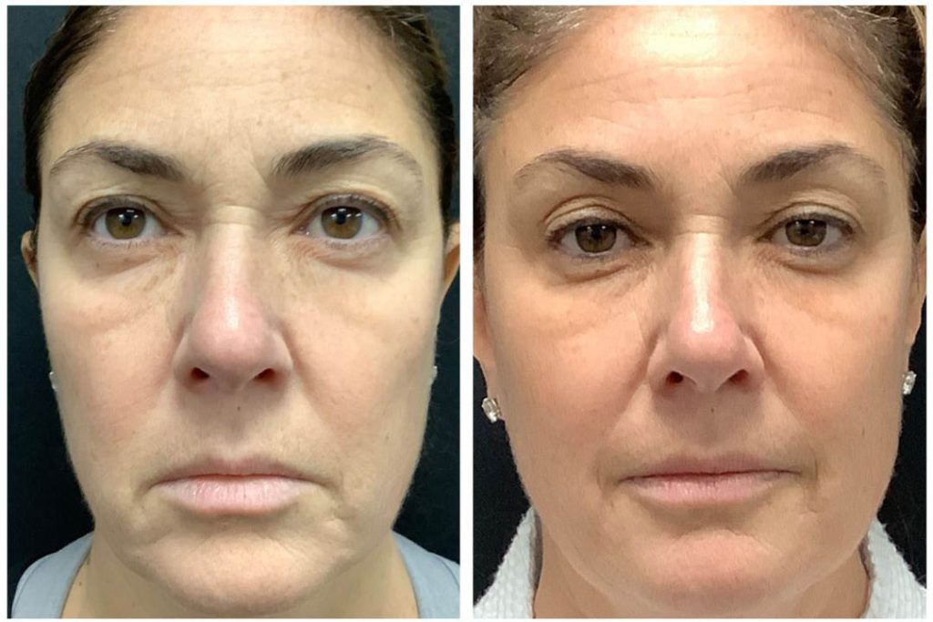 Before and after Secret RF Microneedling in NYC
