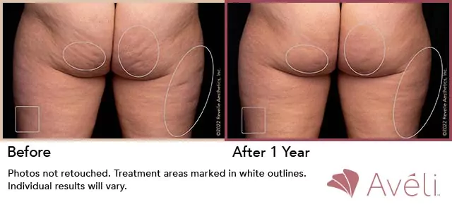 Avéli cellulite reduction on the butt, before and after results