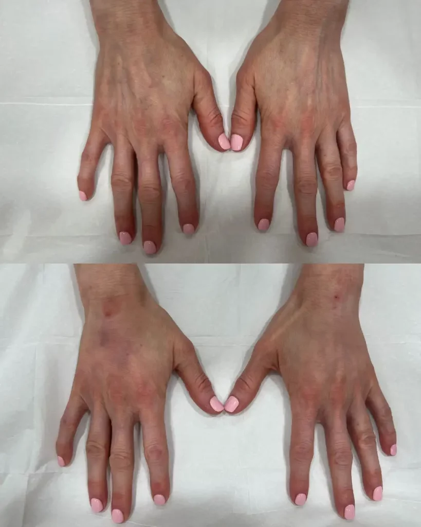 Hand filler before and after results at Skinly Aesthetics NYC, showing volume restoration and smoother skin.