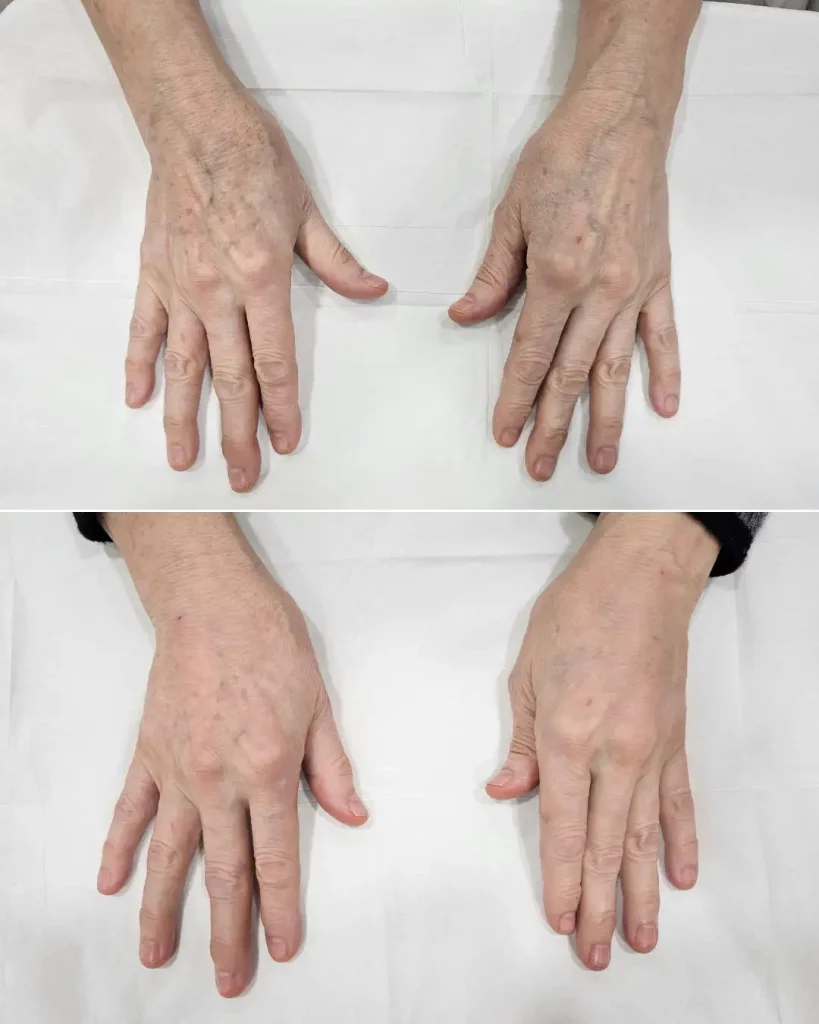 Before and after hand filler treatment performed by Dr. Schwarzburg.