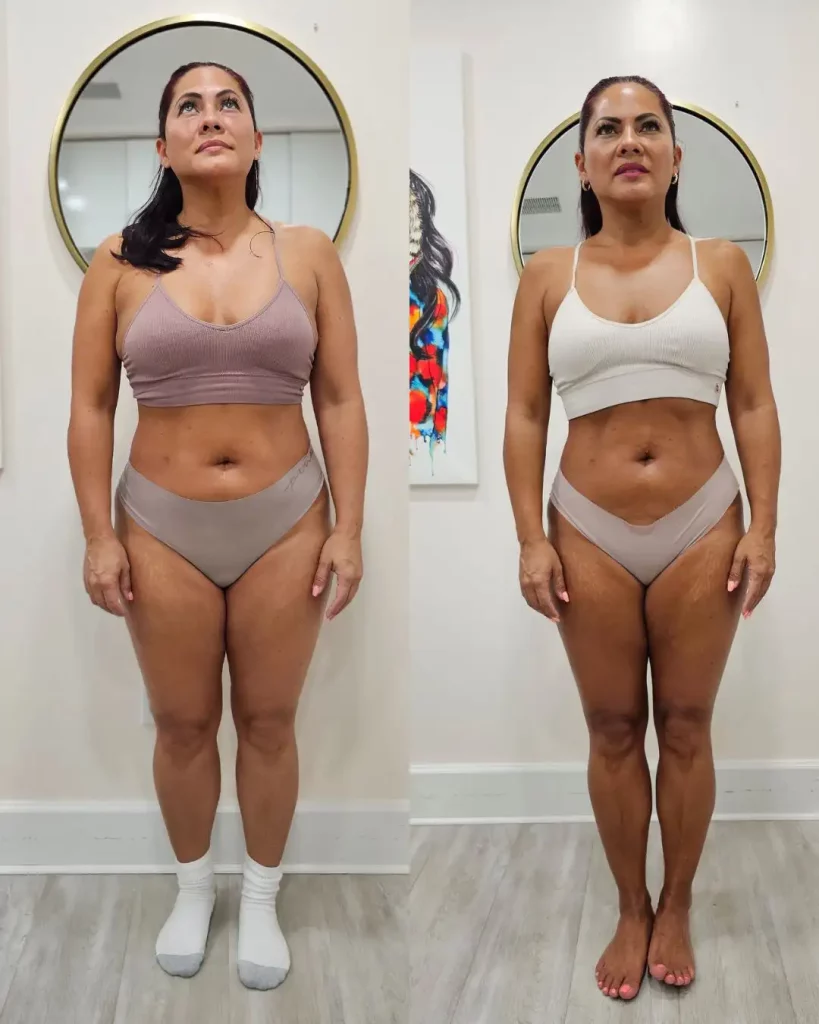 Before and after weight loss results with Ozempic at Skinly Aesthetics in NYC.