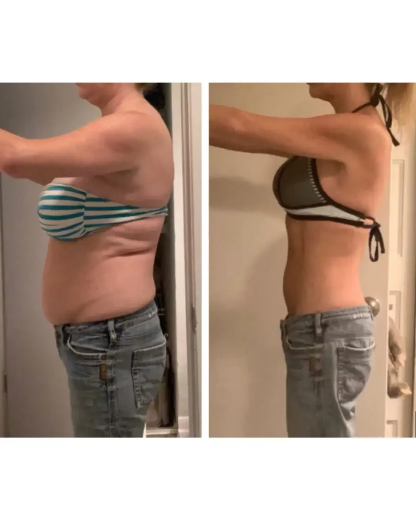 Before and after photos of a patient’s weight loss journey with Ozempic in NYC.