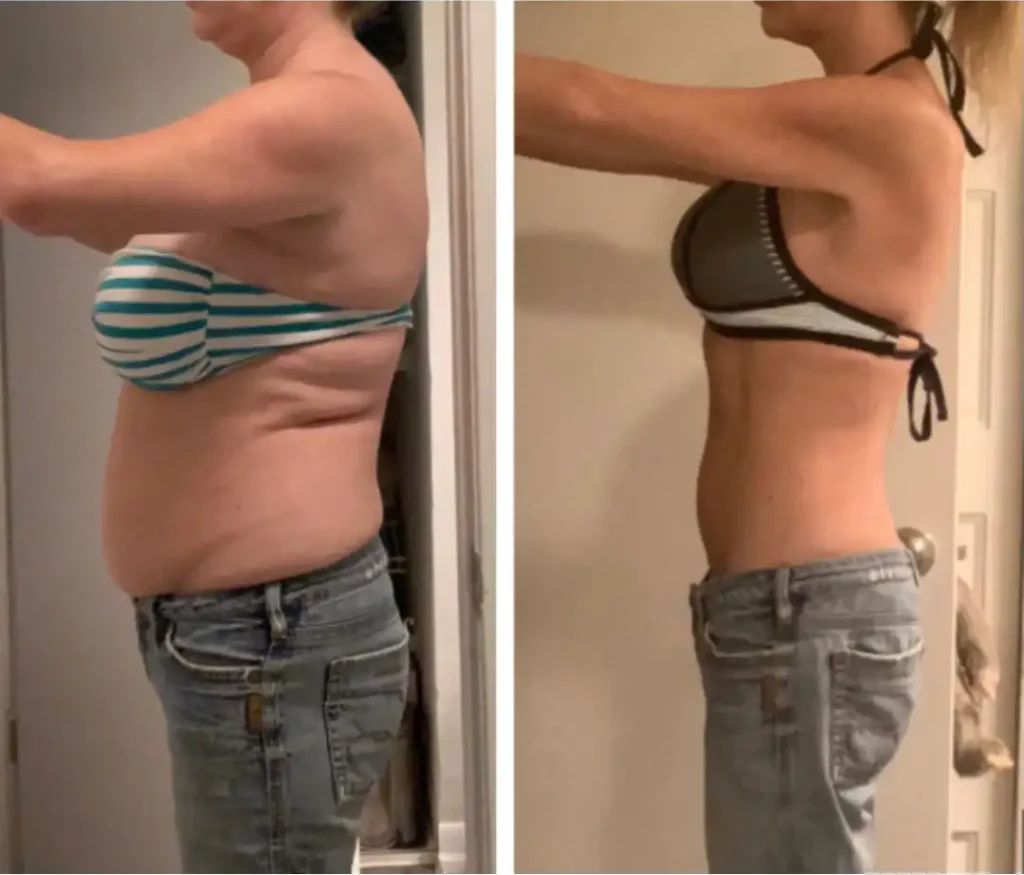 Before and after photos of a patient’s weight loss journey with Ozempic in NYC.