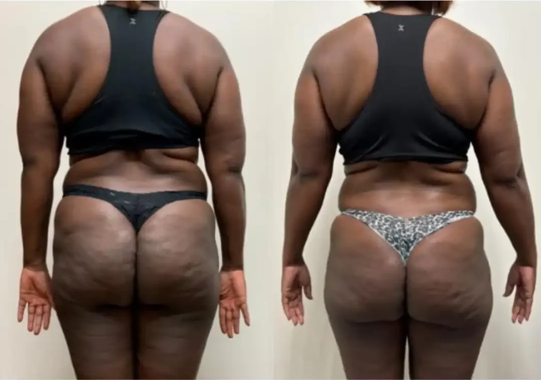 Before and after 6 months of Semaglutide treatment – a patient lost 35 lbs at Skinly Aesthetics in NYC.