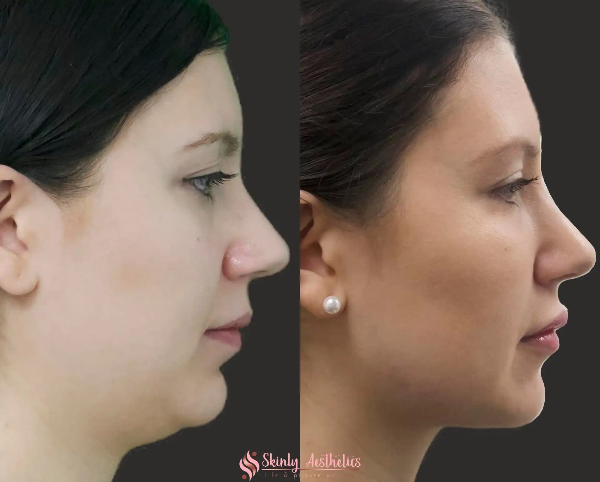 Side profile before and after Kybella treatment demonstrating significant reduction of double chin and improved jawline definition by Dr. Schwarzburg at Skinly Aesthetics in NYC.
