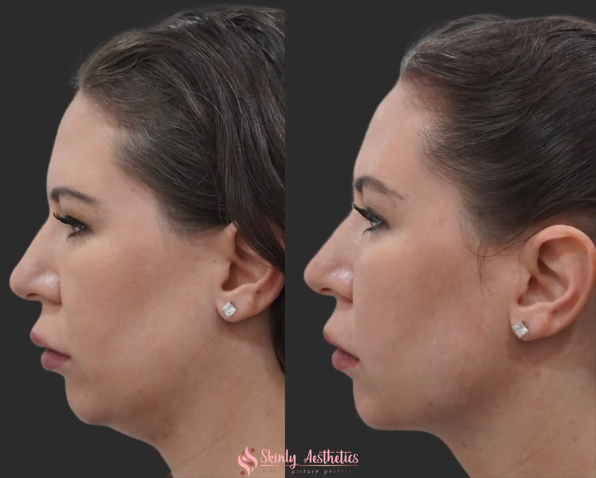 Side view before and after Kybella injections illustrating noticeable improvement in jawline contour and reduction in chin fat.