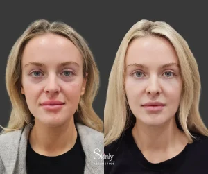 Liquid Facelift before-after showing corrected facial sagging and completely rejuvenated and refreshed look