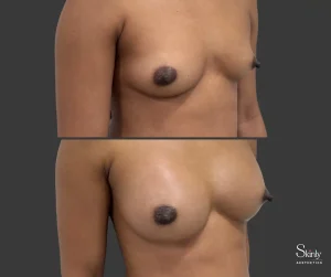 Side profile breast lift results correcting sagging