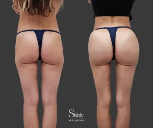 Hyaluronic acid and PLLA filler results from rear side view