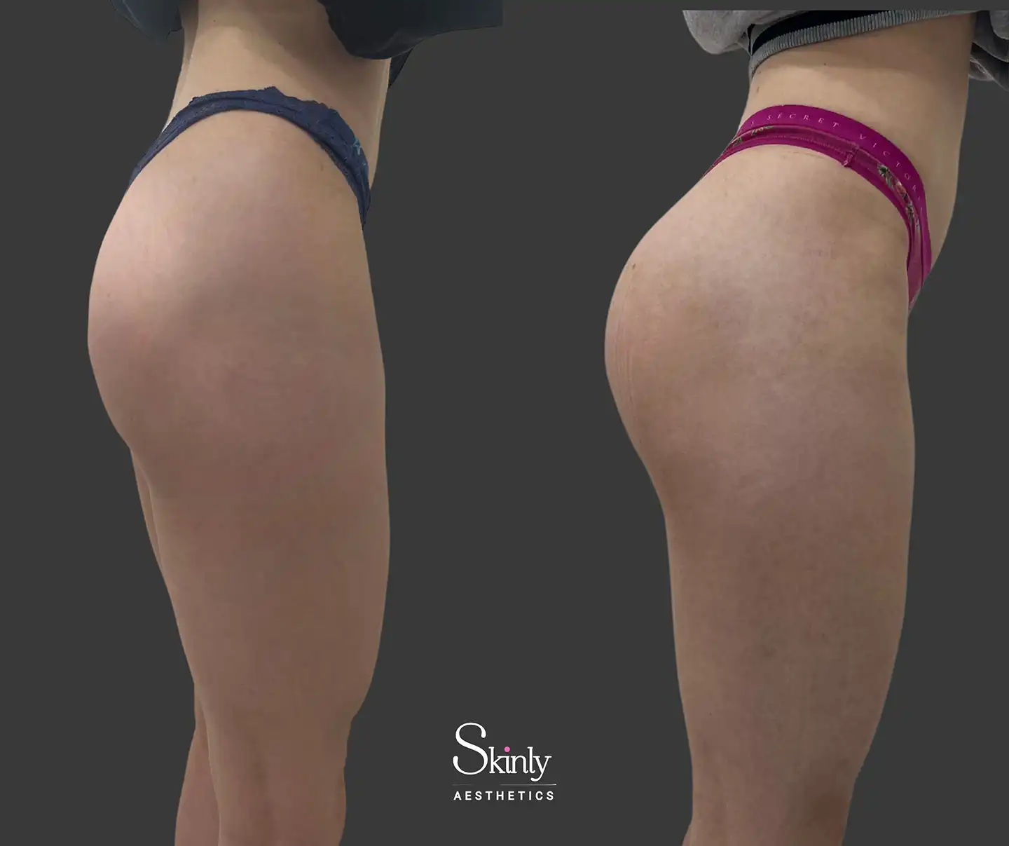 NYC Liquid Butt Lift with HA and PLLA fillers side view