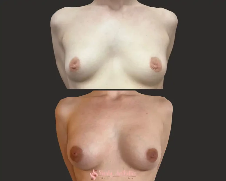 Front-view breast lift results with enhanced volume and shape