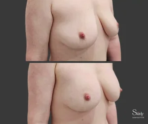 Side-view breast enhancement showing improved volume