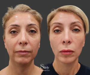 Front view demonstrating lifted eyebrows and rejuvenated midface after liquid facelift