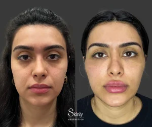 Front view of complete facial rejuvenation including smoother skin, lifted brows, fuller lips, and refreshed eyes after liquid facelift